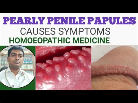 papule penienne|Pearly Penile Papules: Causes, Symptoms & Treatment